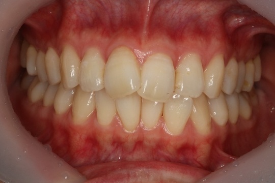 インビザライン あけぼの歯科 平塚市